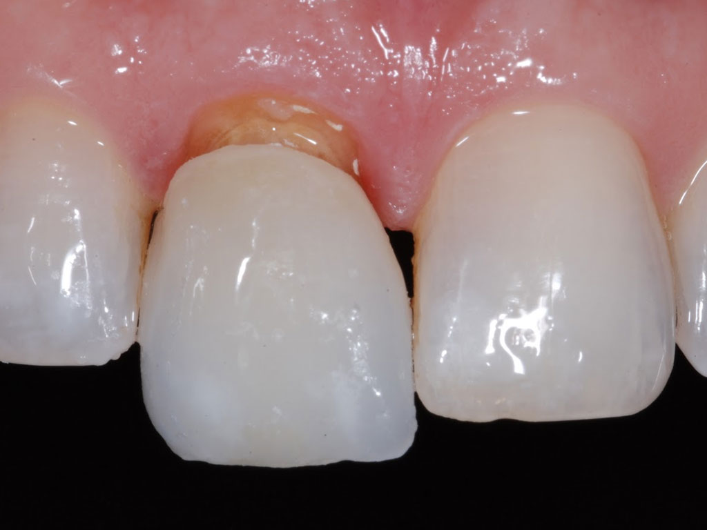 Протезирование зуба коронкой